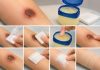 vaseline untuk luka